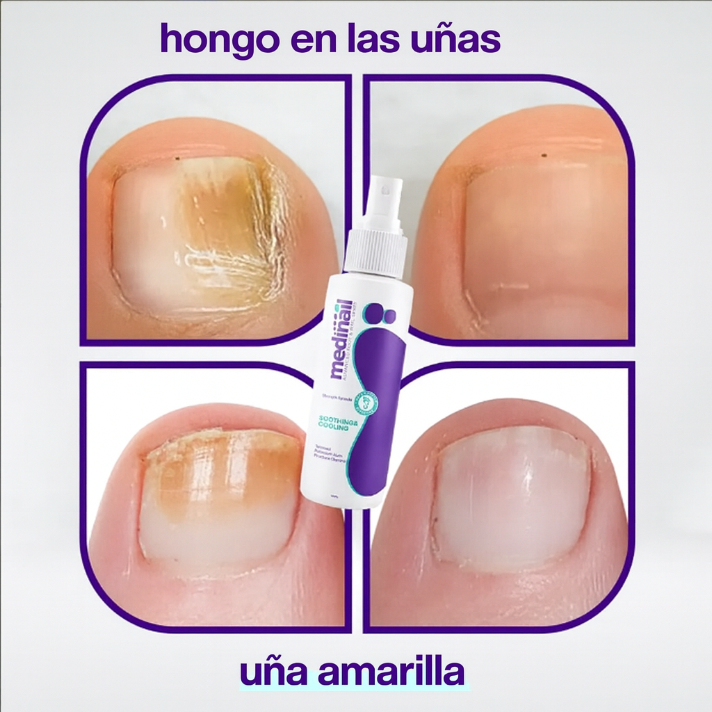 Spray Para Hongos Medinail... Pago contra entrega y envió gratis en Guatemala...