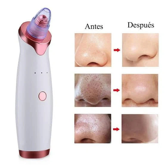 PoreClean Pro® – Miles en Guatemala ya lo usan para decirle adiós a los puntos negros, espinillas y granos
